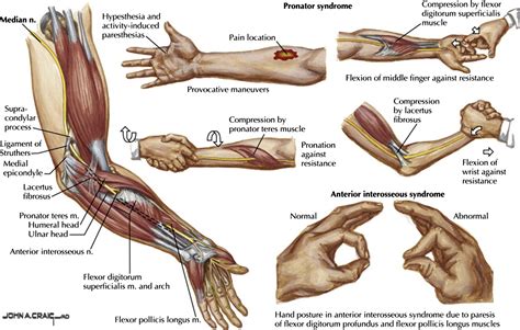 proximal median nerve compression